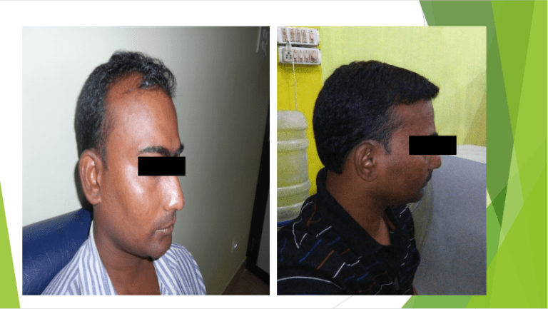 Hair Transplantation