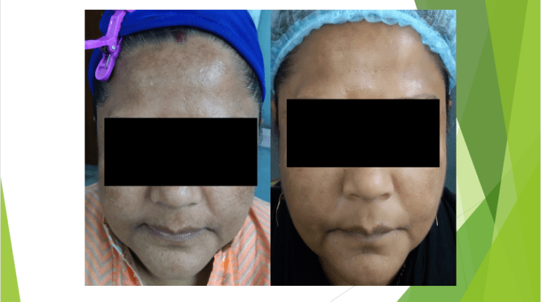 Anti Pigmentation Treatment