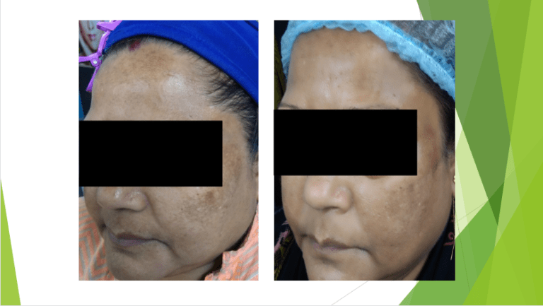 Anti Pigmentation Treatment