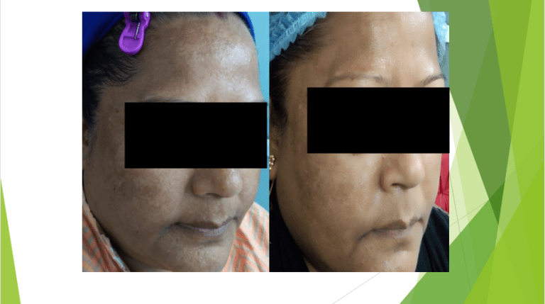 Anti Pigmentation Treatment