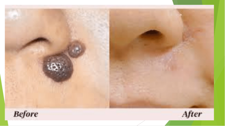 Moles Removal