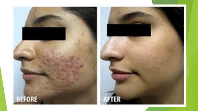 Anti Acne Treatment