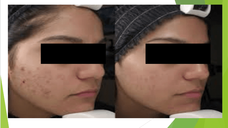 Anti Acne Treatment