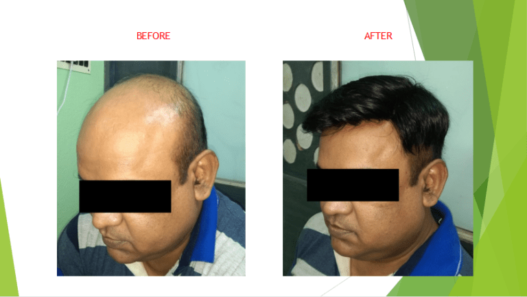 Non surgical Hair Replacement