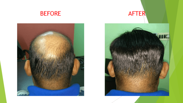 Non surgical Hair Replacement