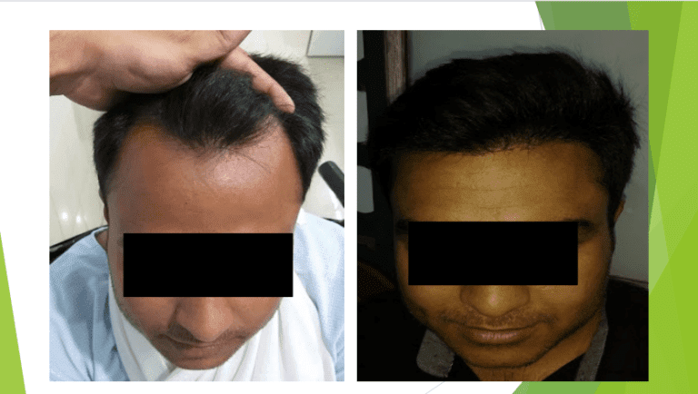 Hair Transplantation