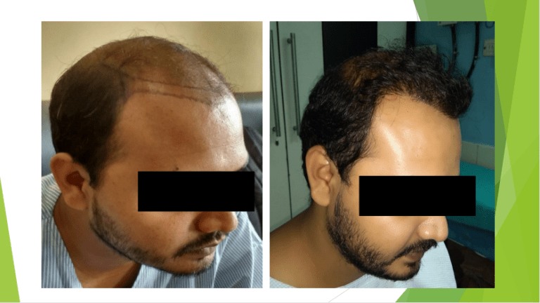 Hair Transplantation