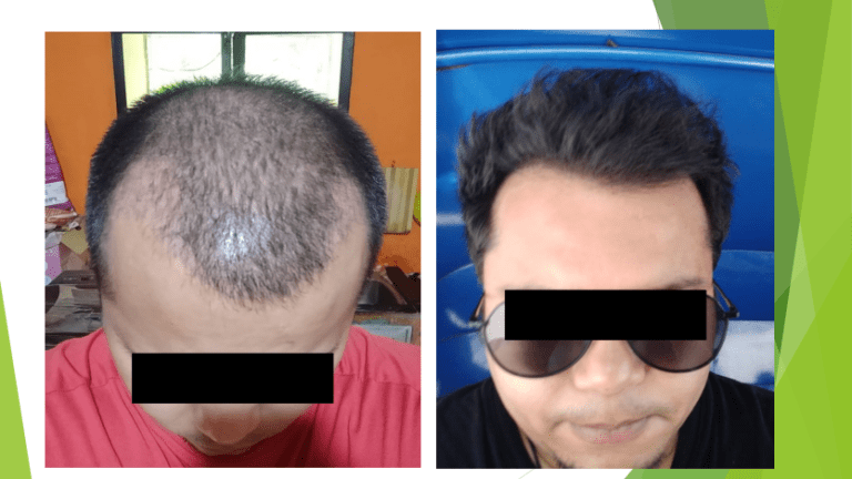 Hair Transplantation