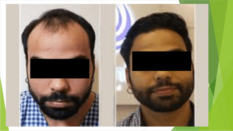 Hair Transplantation