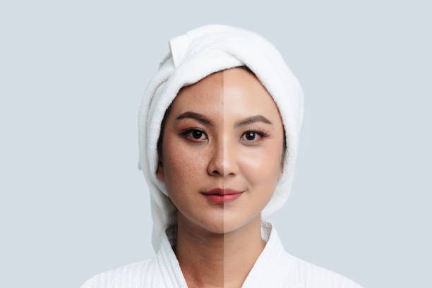 Melasma Treatment