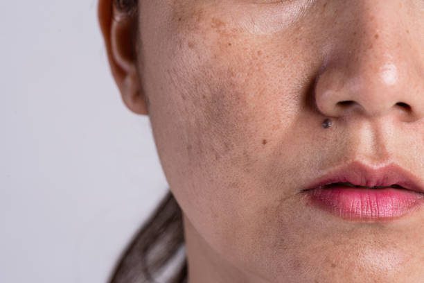 Skin Pigmentation