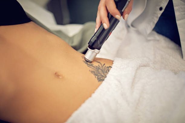 Permanent Tattoo Removal Treatment