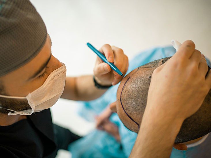 Hair Transplant Consultation